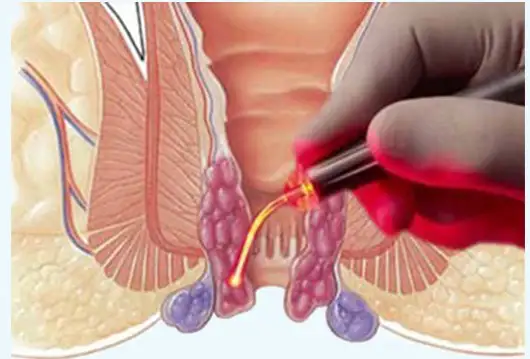 Laser Piles Treatment in Kanker - Shri Ganpati Piles Clinic
