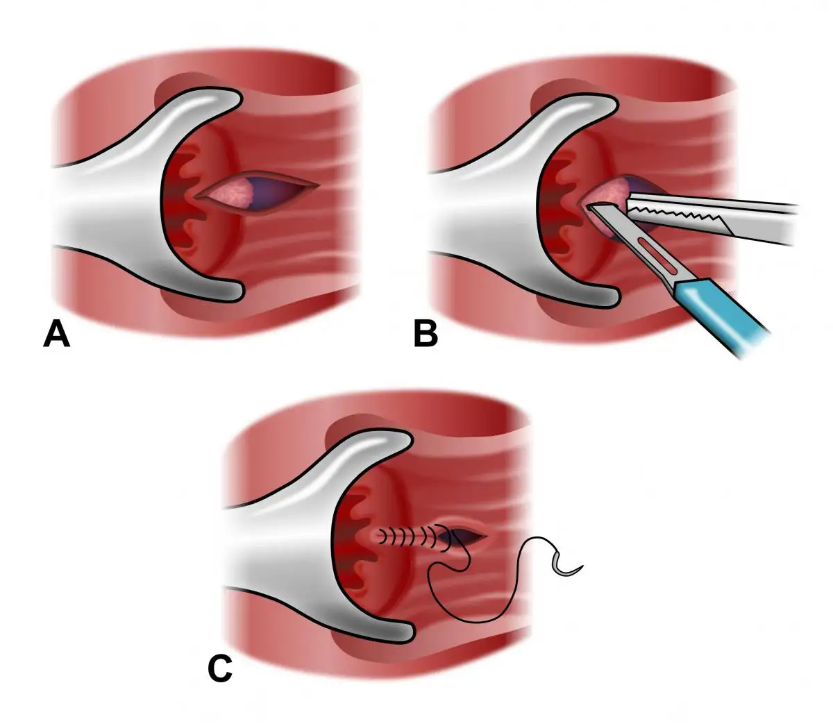 Fissure Treatment in Akaltara - Shri Ganpati Piles Clinic