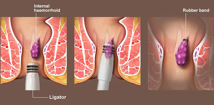 Non Surgical Piles Treatment in Panchsheel Nagar Raipur - Shri Ganpati Piles Clinic