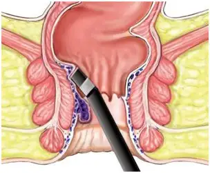 Fissure Treatment in Akaltara - Shri Ganpati Piles Clinic