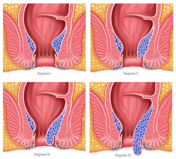 Non Surgical Piles Treatment in Rajnandgaon - Shri Ganpati Piles Clinic